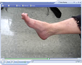 Post-Operation Foot Drop video with Dr. Nath