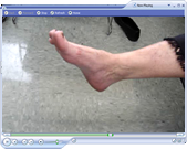 Post-Operation Foot Drop Video with Dr. Nath